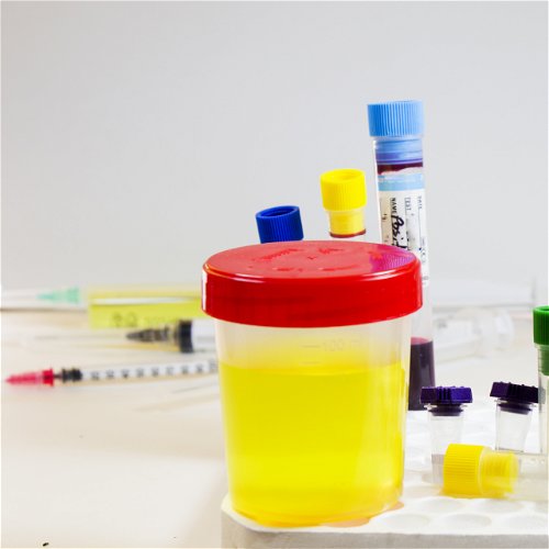 Navike koje pogoduju razvoju urinarnih infekcija