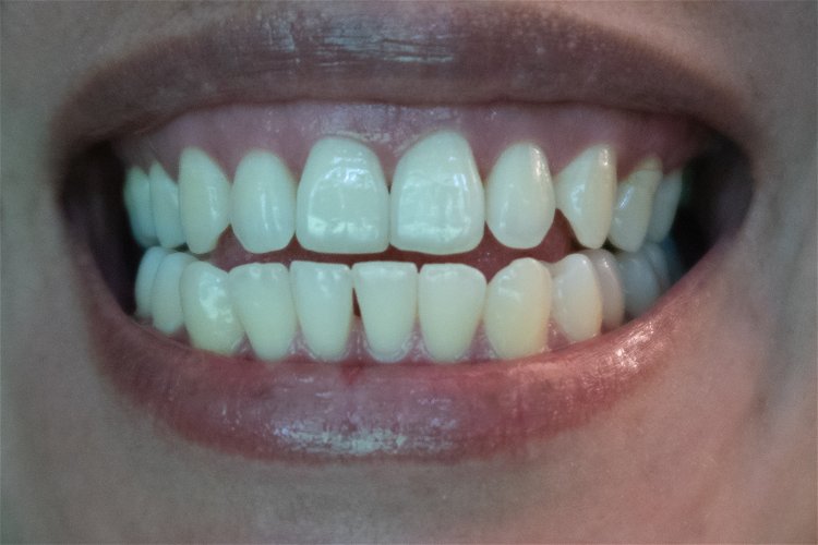 Na koje sve načine možete popraviti slomljen zub?